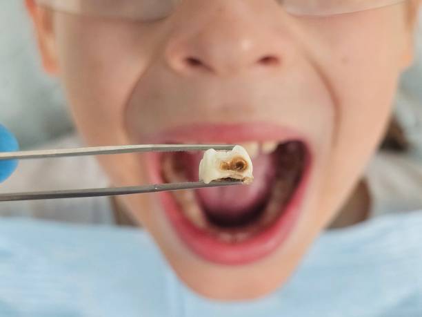 Best Emergency Root Canal Therapy in Ash Flat, AR