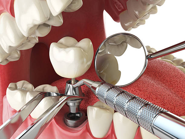 Best Broken or Chipped Tooth Repair in Ash Flat, AR